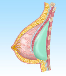 breast diagram 2