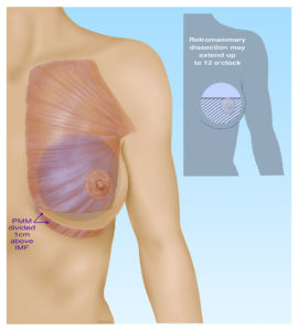 breast diagram 3