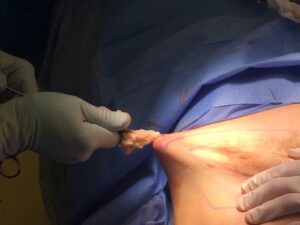 Mammoplasty Archives - Surgery in Peru