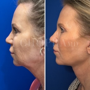 Facelift before and after photo