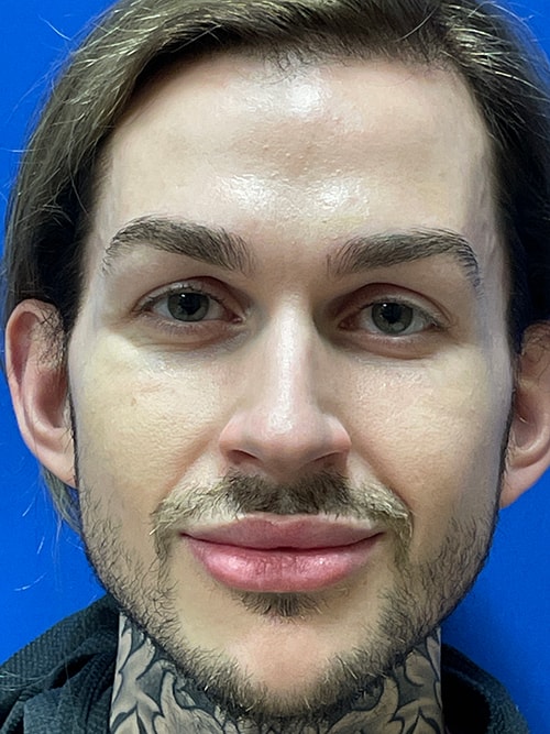 What are the Different Types of Nose Shapes?