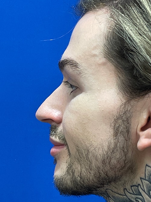 button nose side profile Thomas Uncin1965