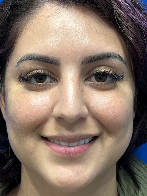 button nose side profile Thomas Uncin1965