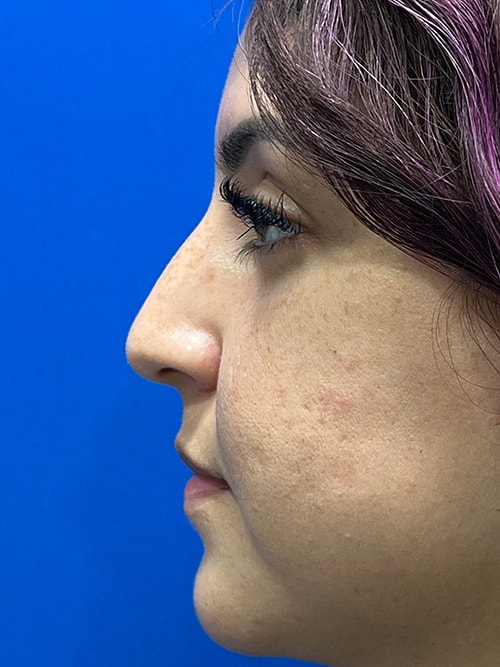 button nose side profile Thomas Uncin1965