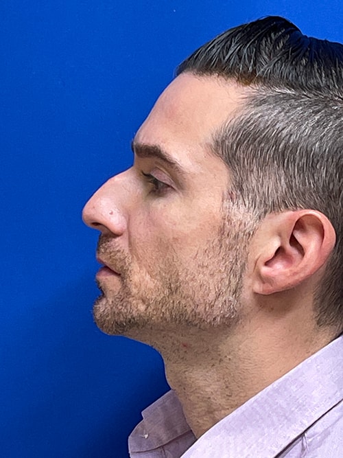 What are the Different Types of Nose Shapes?