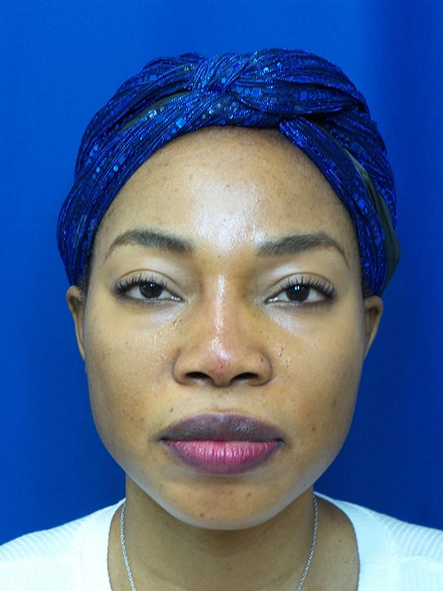 button nose side profile Thomas Uncin1965