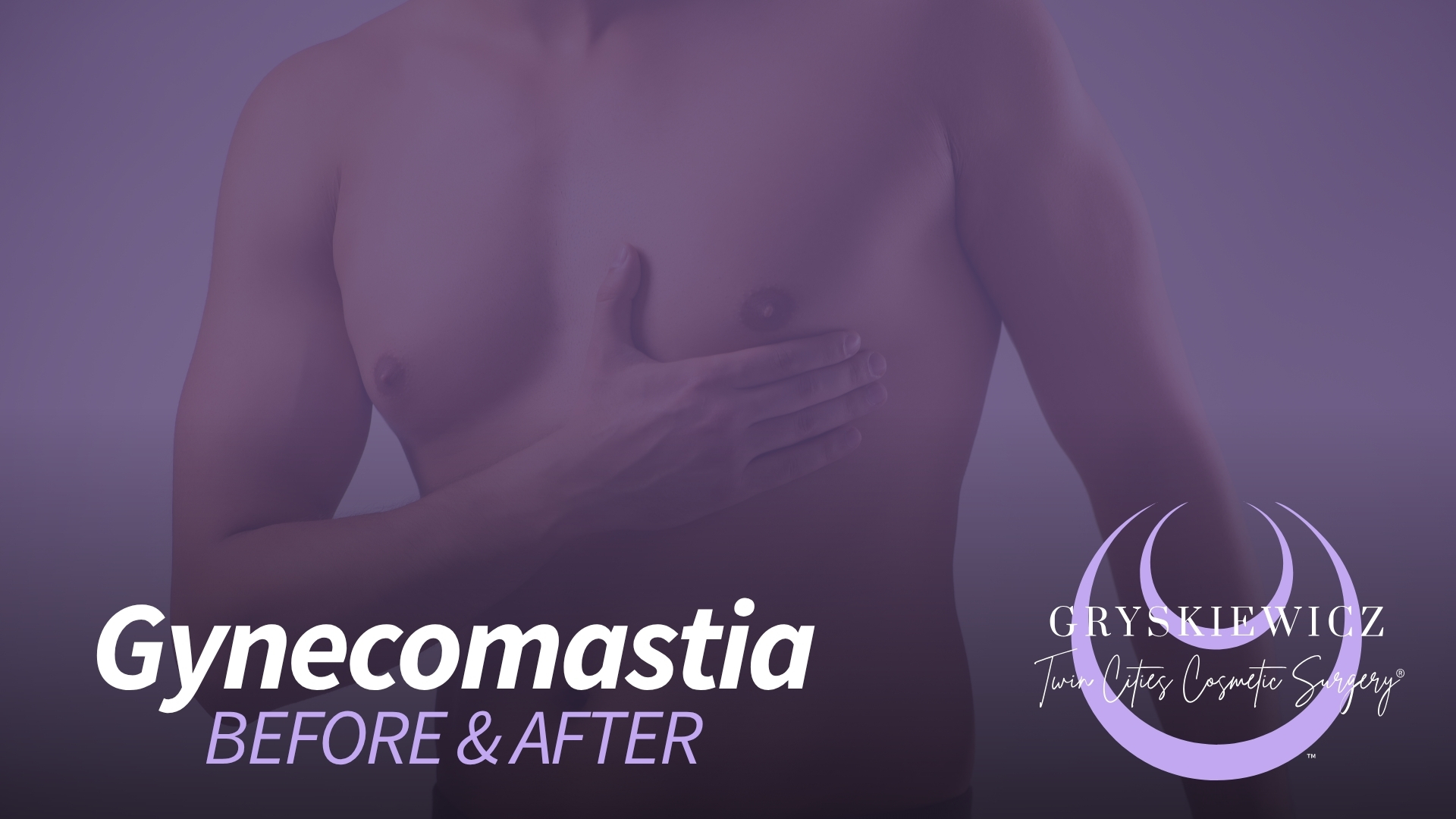 Gynecomastia Before and After Video