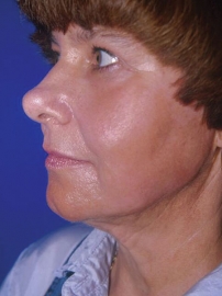 Neck Lift Twin Cities, Platysmaplasty St. Paul